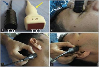 Transcranial Doppler Ultrasonography as a Diagnostic Tool for Cerebrovascular Disorders
